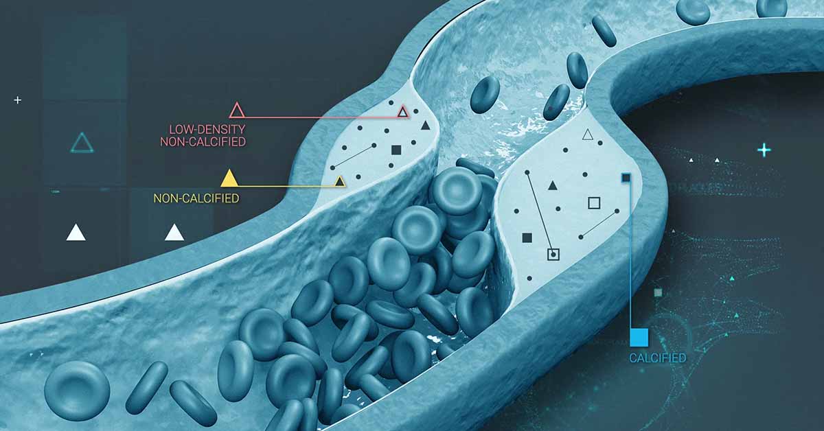 Arterial plaque: How heart plaques affect cardiovascular health