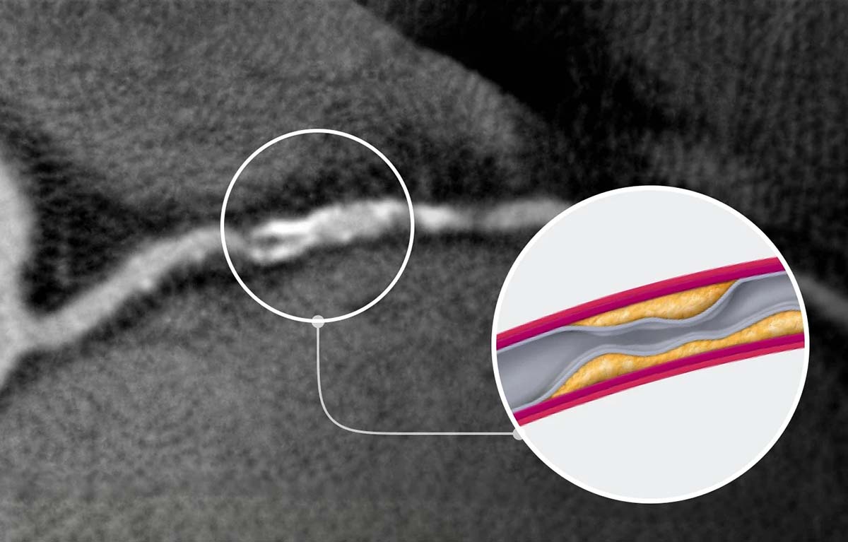 Ischemia (reduced blood flow)