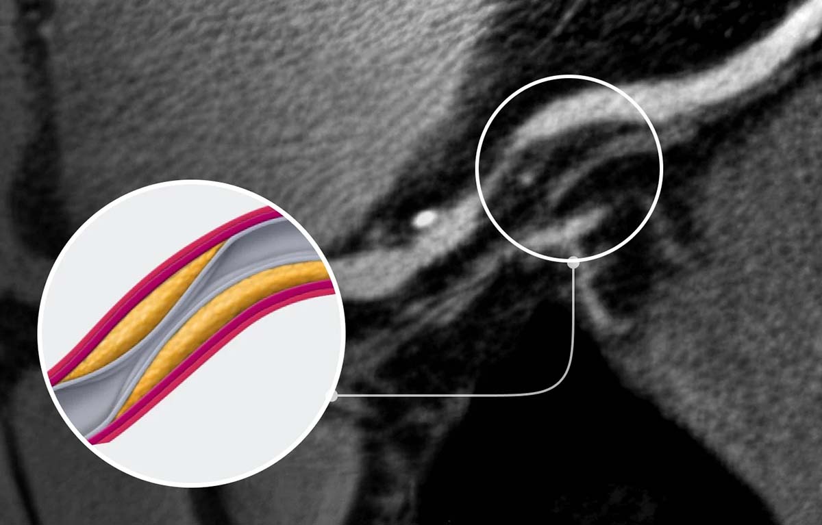 Stenosis (narrowing)